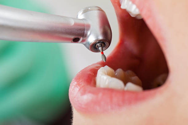 Best Emergency Root Canal Treatment in Union City, TN